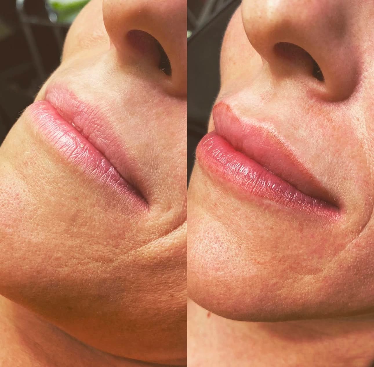 Lip blushing before and after, showing restored colour and lip border definition